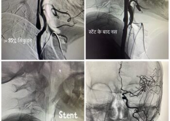 AIIMS ऋषिकेश में भी ब्रेन व स्पाइन की खून की नसों की बीमारियों का बिना चीरफाड़ के उपचार
